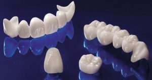 Безметалловая керамическая коронка