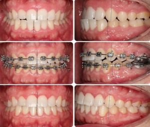 Металлические брекеты цена