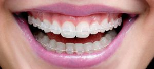 Сапфировые брекеты позняки