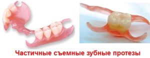 Частичные съемные протезы