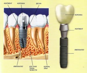 имплантация зубов позняки