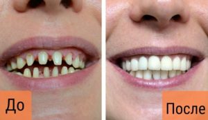 металокерамика киев