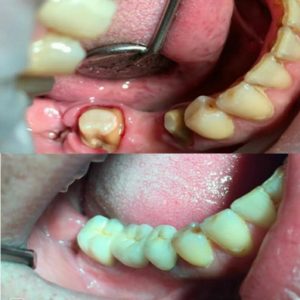 металокерамика установка позняки